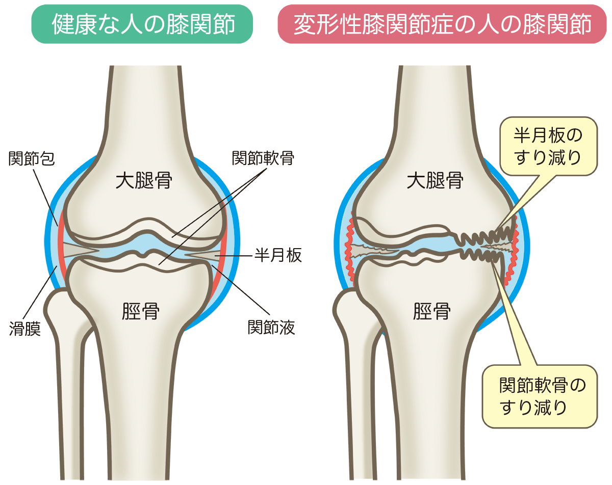 変形性膝関節症の原因